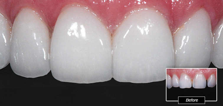 Dental Procedure - Before and After photo