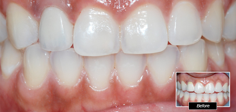 Dental Procedure - Before and After photo