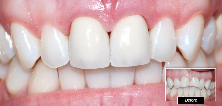 Dental Procedure - Before and After photo