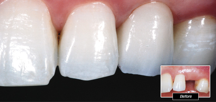 Dental Procedure - Before and After photo