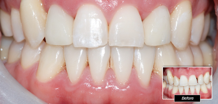 Dental Procedure - Before and After photo