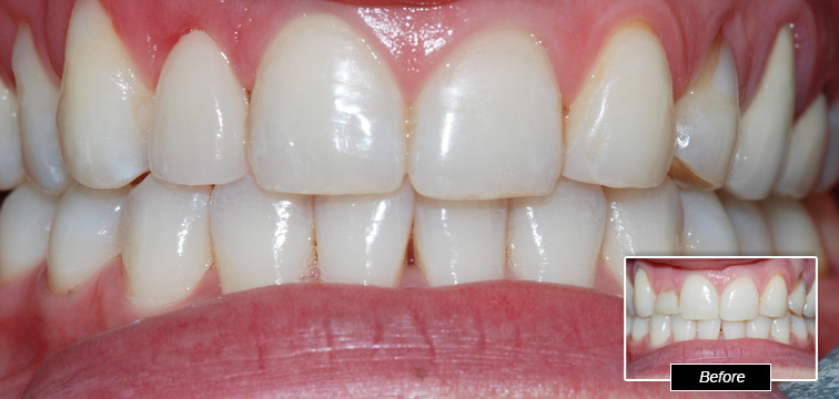 Dental Procedure - Before and After photo