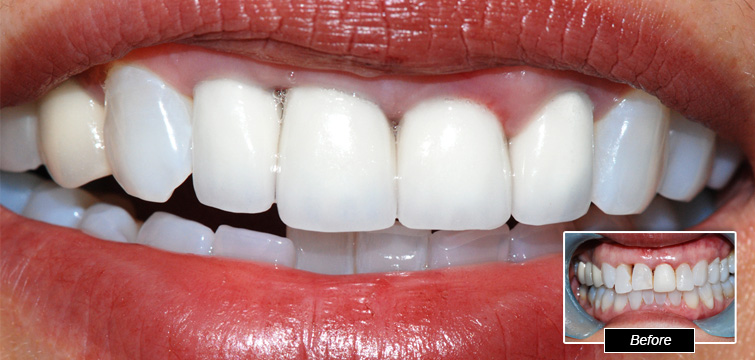 Dental Procedure - Before and After photo
