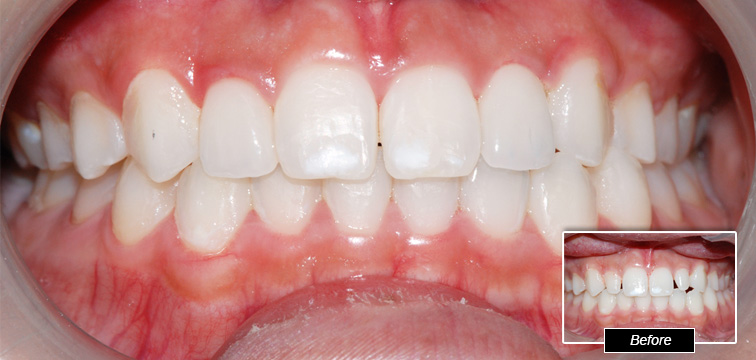Dental Procedure - Before and After photo