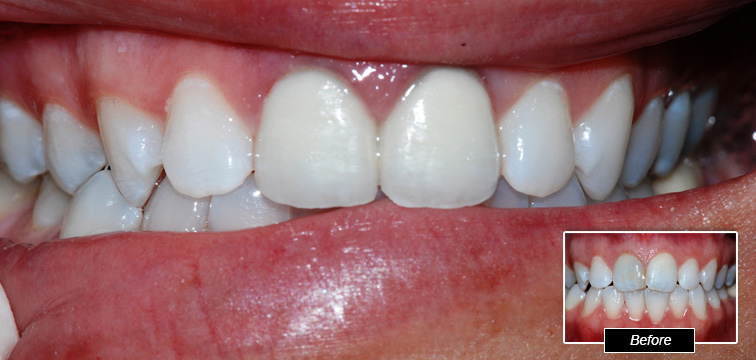 Dental Procedure - Before and After photo