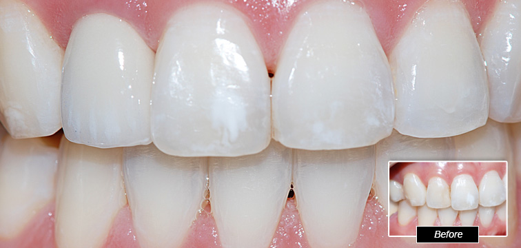 Dental Procedure - Before and After photo