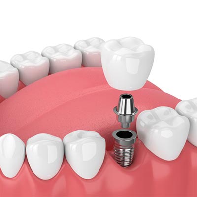 Dental Implant